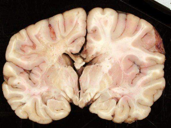 2B4 Adrenoleukodystrophy (Case 2) 6