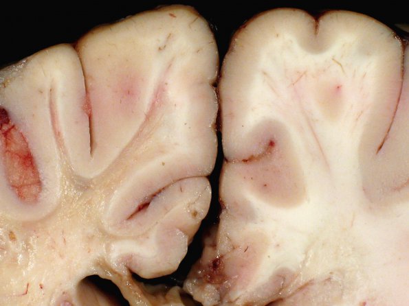 2B5 Adrenoleukodystrophy (Case 2) 7