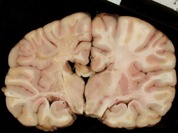 2B7 Adrenoleukodystrophy (Case 2) 9