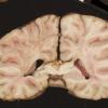 2B8 Adrenoleukodystrophy (Case 2) 11