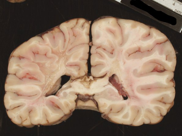 2B8 Adrenoleukodystrophy (Case 2) 11