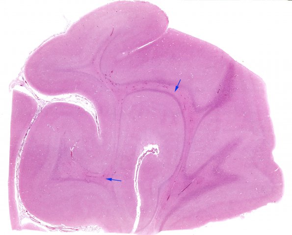 2C1 Adrenoleukodystrophy (Case 2) H&E whole mount 1 copy