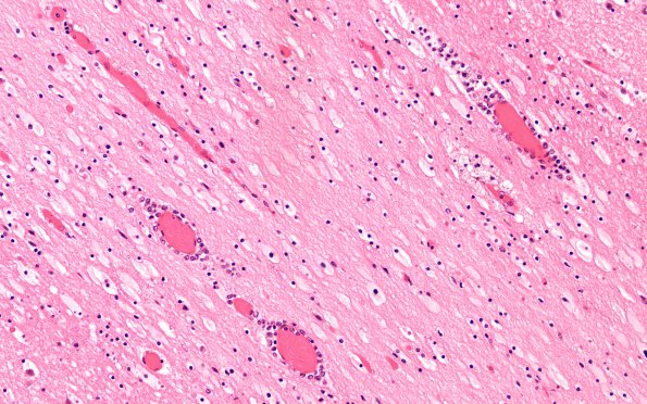 2C4 Adrenoleukodystrophy (Case 2) N15 H&E 1