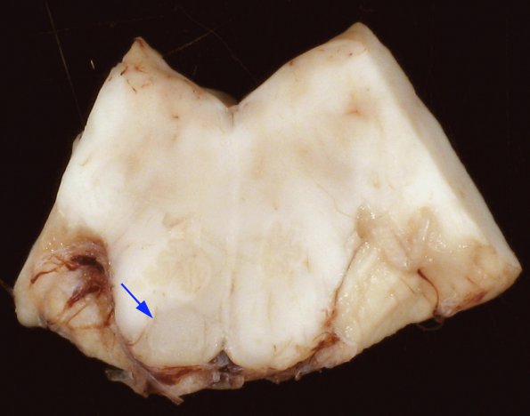 2D1 Adrenoleukodystrophy (Case 2) 17 copy