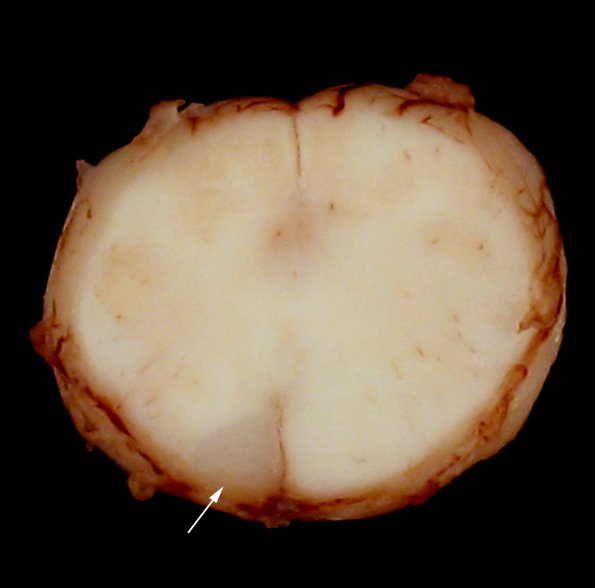 2D2 Adrenoleukodystrophy (Case 2) 20 copy