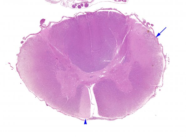 2E1 Adrenoleukodystrophy (Case 2) N10 H&E WM copy