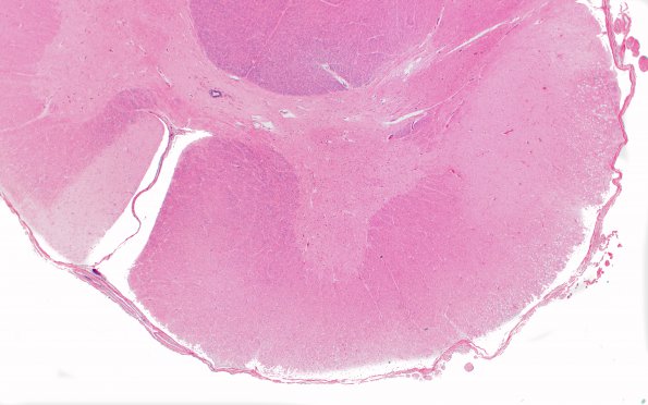 2E2 Adrenoleukodystrophy (Case 2) N10 H&E 2