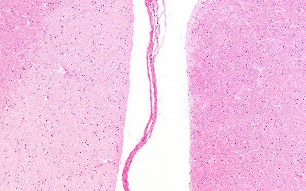 2E3 Adrenoleukodystrophy (Case 2) N10 H&E 1