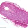 2F Adrenoleukodystrophy (Case 2) adrenal H&E whole mount (line 1 mm)