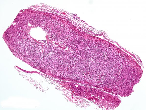 2F Adrenoleukodystrophy (Case 2) adrenal H&E whole mount (line 1 mm)