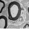 2H1 Adrenoleukodystrophy (Case 2) EM 2 - Copy