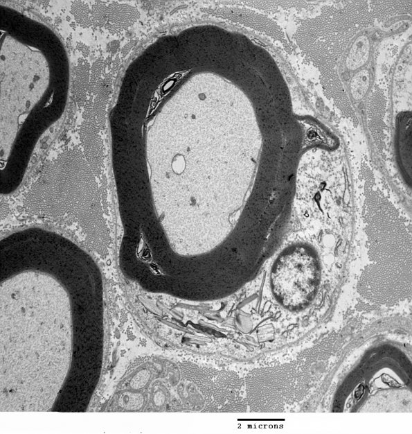 2H1 Adrenoleukodystrophy (Case 2) EM 2 - Copy