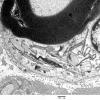 2H2 Adrenoleukodystrophy (Case 2) 4 - Copy