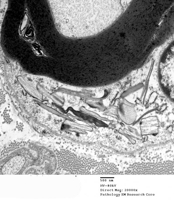 2H2 Adrenoleukodystrophy (Case 2) 4 - Copy