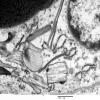 2H3 Adrenoleukodystrophy (Case 2) 6 - Copy