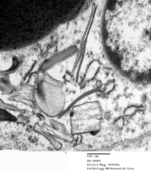 2H3 Adrenoleukodystrophy (Case 2) 6 - Copy