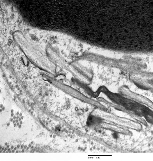 2H4 Adrenoleukodystrophy (Case 2) EM 5 - Copy