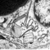 2H5 Adrenoleukodystrophy (Case 2) EM 6 - Copy