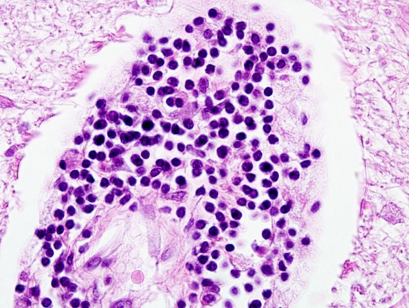 3A8 Adrenoleukodystrophy (AANP Case 2003-10) H&E 100X Oil for control