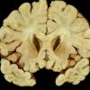 4A1 Adrenoleukodystrophy (Case 4) 10