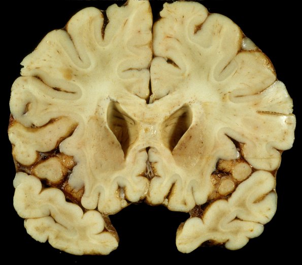 4A1 Adrenoleukodystrophy (Case 4) 10