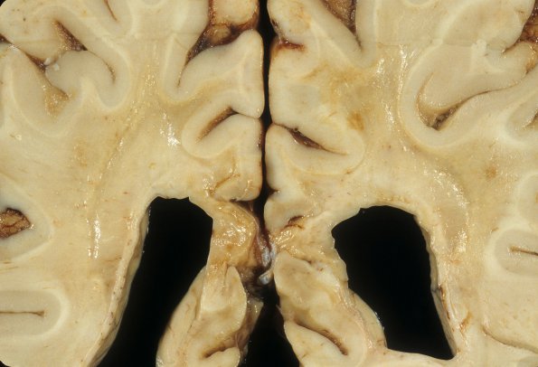 4A10 Adrenoleukodystrophy (Case 4) 28