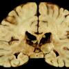 4A2 Adrenoleukodystrophy (Case 4) 15