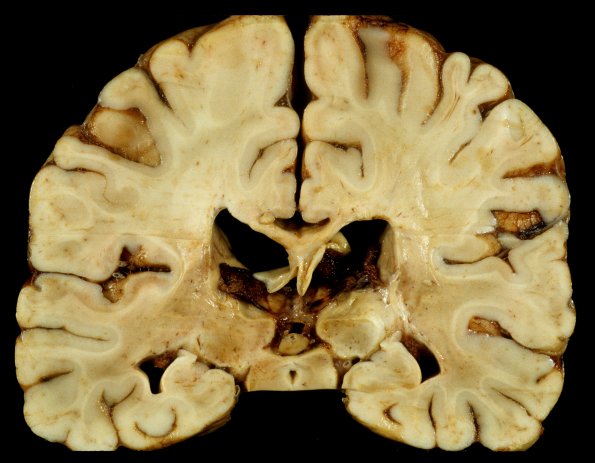 4A2 Adrenoleukodystrophy (Case 4) 15