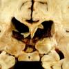 4A3 Adrenoleukodystrophy (Case 4) 14