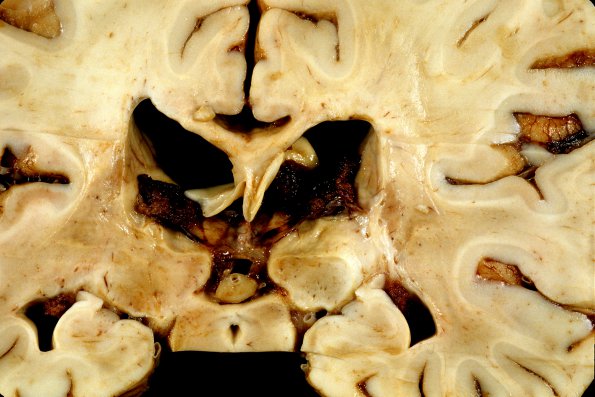 4A3 Adrenoleukodystrophy (Case 4) 14