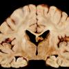 4A5 Adrenoleukodystrophy (Case 4) 19