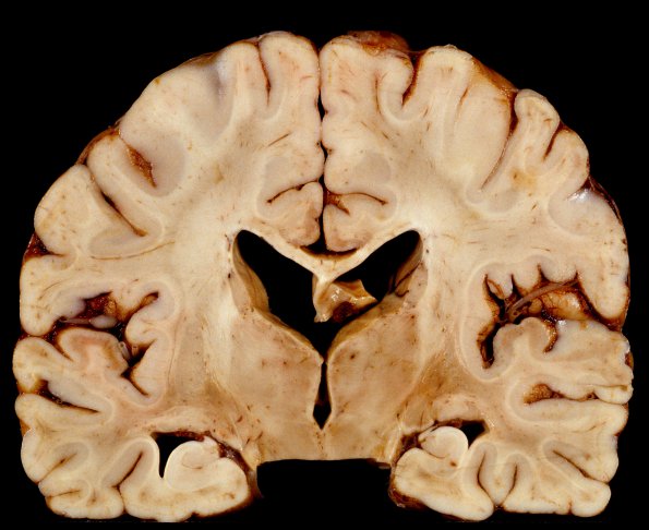 4A5 Adrenoleukodystrophy (Case 4) 19