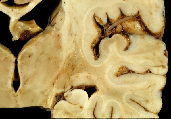 4A6 Adrenoleukodystrophy (Case 4) 20