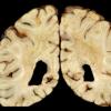 4A7 Adrenoleukodystrophy (Case 4) 21