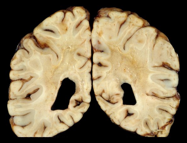 4A7 Adrenoleukodystrophy (Case 4) 21