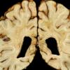 4A8 Adrenoleukodystrophy (Case 4) 27