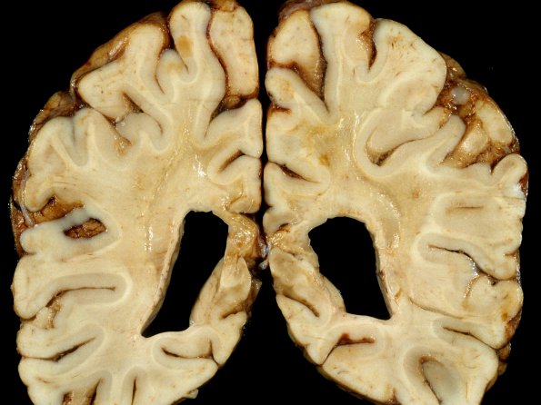 4A8 Adrenoleukodystrophy (Case 4) 27