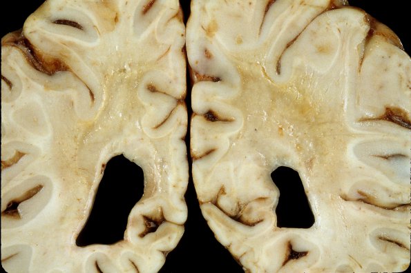 4A9 Adrenoleukodystrophy (Case 4) 22