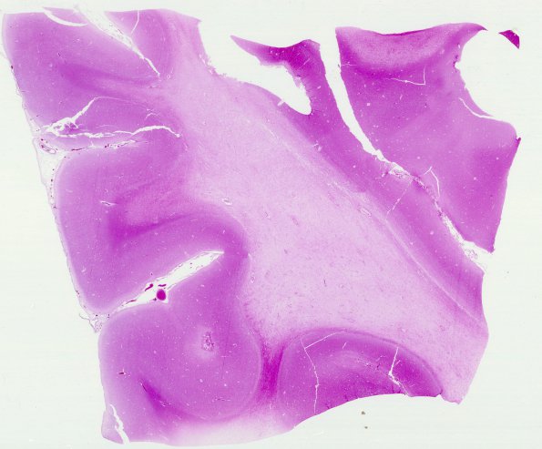 4B1 Adrenoleukodystrophy (Case 4) N14 H&E whole mount