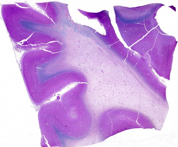 4B2 Adrenoleukodystrophy (Case 4) N14 LFB-PAS whole mount