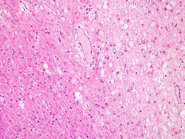 4C1 Adrenoleukodystrophy (Case 4) SP BMT w immunosupression, ABCD1 mutation H&E 3