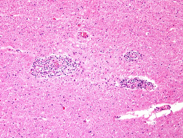 4C2 Adrenoleukodystrophy (Case 4) SP BMT w immunosupression, ABCD1 mutation, H&E 9