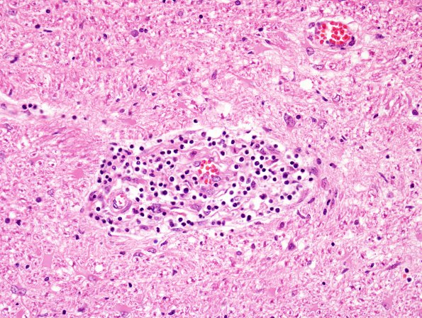 4C3 Adrenoleukodystrophy (Case 4) SP BMT w immunosuppression, ABCD1 mutation H&E 8