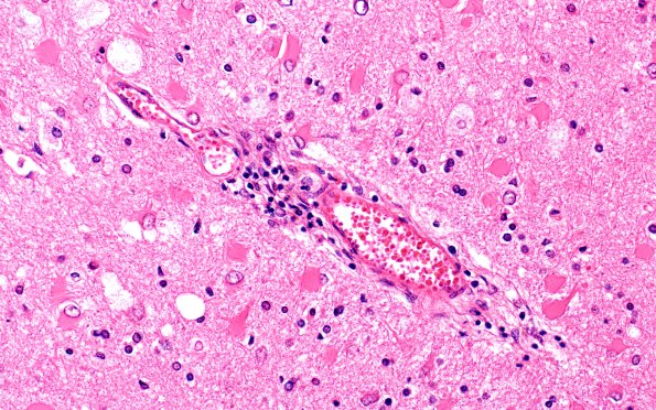 4C4 Adrenoleukodystrophy (Case 4) SP BMT w immunosuppression, ABCD1 mutation H&E 7