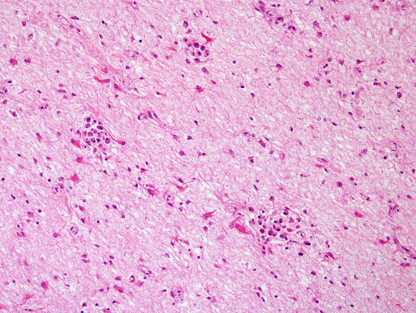 4C5 Adrenoleukodystrophy (Case 4) SP BMT w immunosuppression, ABCD1 mutation H&E 5