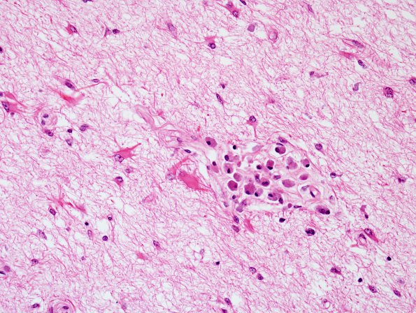 4C6 Adrenoleukodystrophy (Case 4) SP BMT w immunosuppression, ABCD1 mutation H&E 6