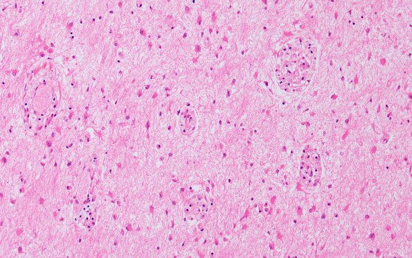 4C7 Adrenoleukodystrophy (Case 4) SP BMT w immunosupression, ABCD1 mutation H&E 7