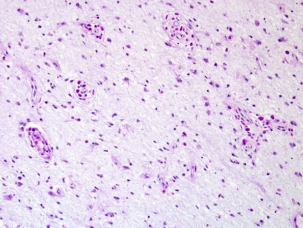 4D2 Adrenoleukodystrophy (Case 4) SP BMT w immunosupression, ABCD1 mutation LFB-PAS 2