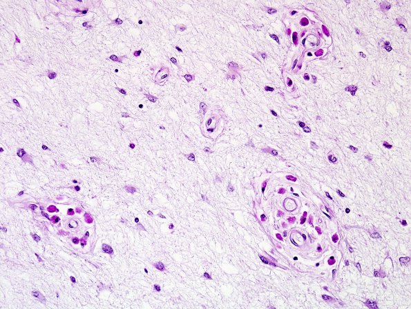 4D3 Adrenoleukodystrophy (Case 4) SP BMT w immunosupression, ABCD1 mutation LFB-PAS 3