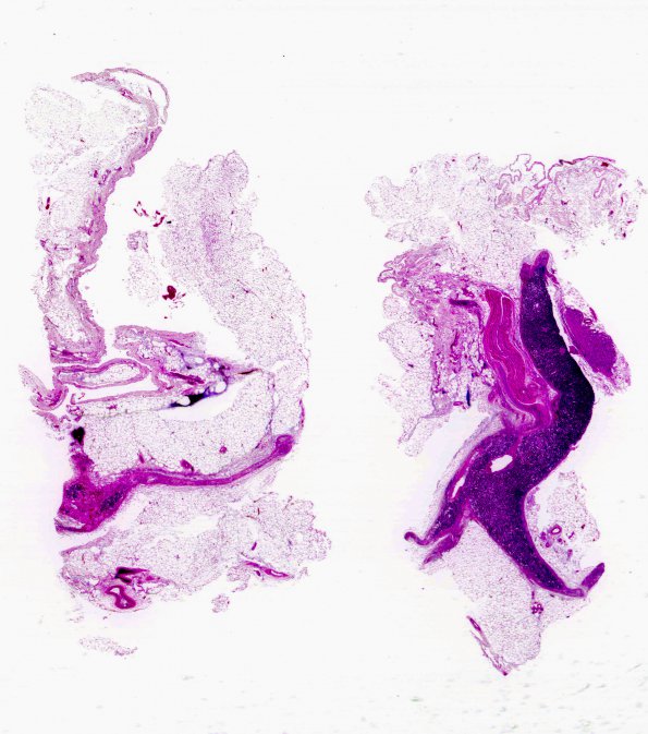 4F2 Adrenoleukodystrophy (Case 4) adrenal gland H&E whole mount residual medulla 